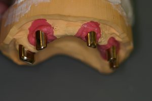 Implantatbrücke: 2